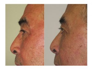 smoother lower eyelid