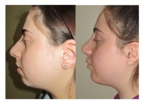 chin implant and rhinoplasty
