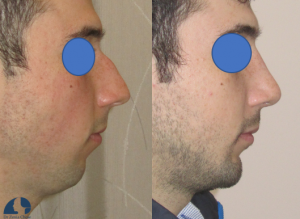 Chin augmentation and rhinoplasty